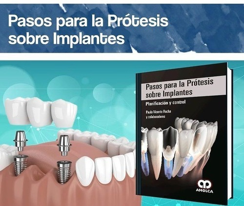 Pasos Para La Prtesis Sobre Implantes Planificacin ,jk