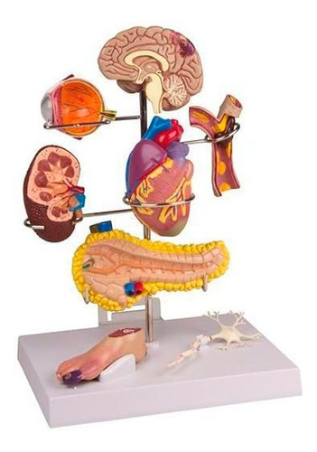 Modelo Complicaciones De La Diabetes