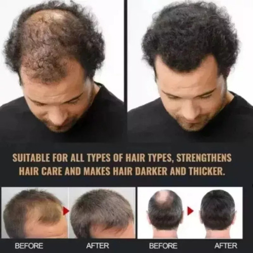 ChampĂș Root Activator Para El Crecimiento Del Cabello Para H