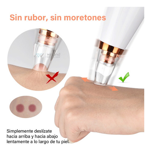 Removedor Espinillas,6 Sondas Succión Limpiadora Poros Acné