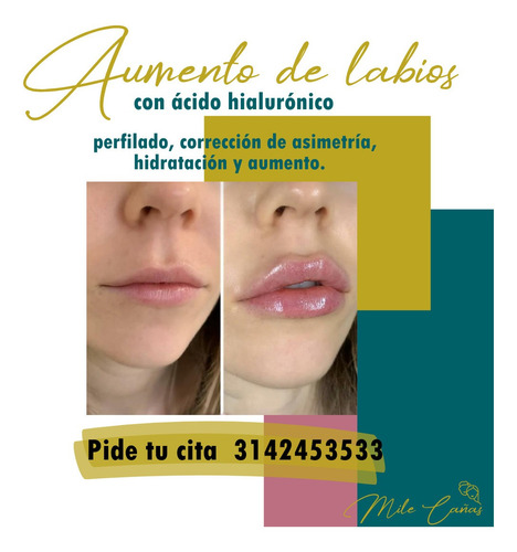 Imagen 4 de 5 de Aumento Y Perfilacion De Labios