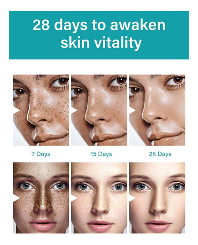 V Freckle - Crema Removedora Y Blanqueadora - 30 G Para Hidr