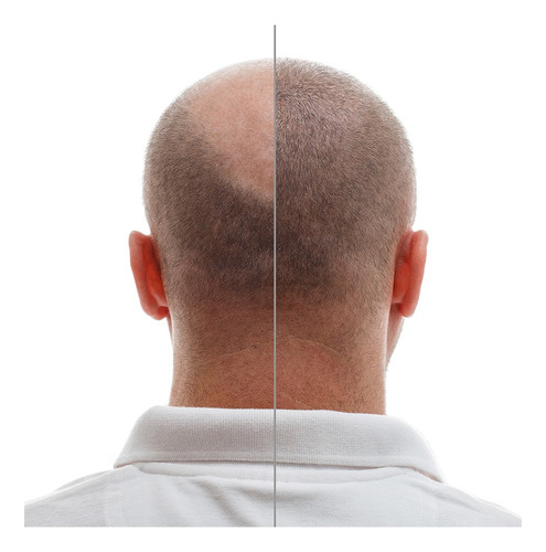 Minoxidil 1mg 100 Tabletas Minoxihead