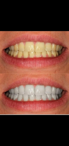 Pasta De Dientes Desmanchadora Coreana