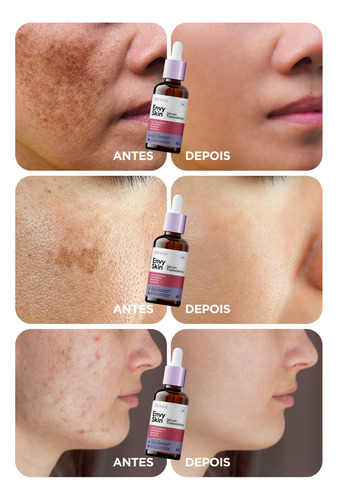 Sérum Facial Melasma E Acne Com Ácido Tranexâmico Acneica Noite