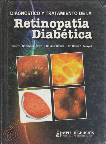 Retinopatia Diabetica Diagnostico Y Tratamiento Dr Samuel B