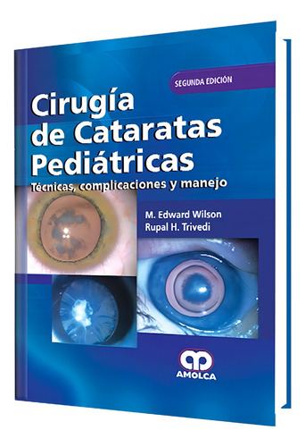 Cirugía de Cataratas Pediátricas Técnicas Complicaciones y Manejo tapa dura