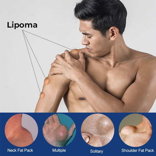 - Crema Para Eliminar Lipomas, Crema Limpiadora De Lipomas