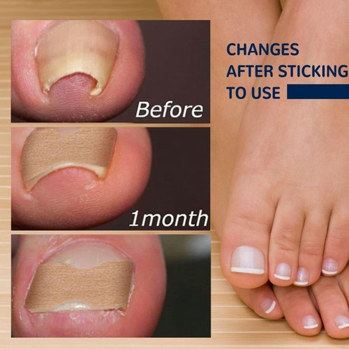 Parche Correctivo De Uñas Eelhoe De 3 Piezas, Parche Para Uñ