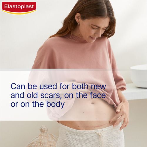 Emplastros Redutores De Cicatrizes, Elastoplasto, Tratamento