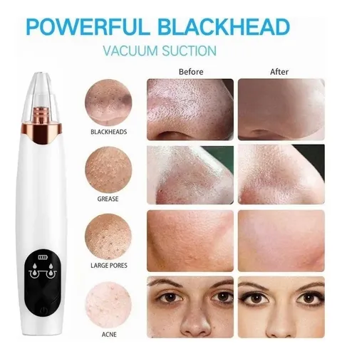 Kit De Cuidado Facial, Eliminación Del Acné, Fregador, Ems