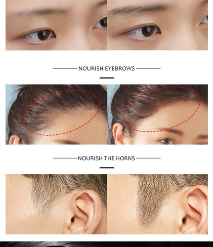 Aceite Sérum Anticaída Del Cabello Calvicie Alopecia Masajes
