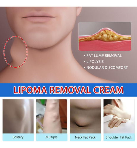 Jx Crema Limpiadora Para Lipomas Nc4c, Bloqueadora Grasa, 20