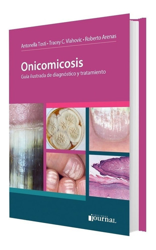 Tosti / Arenas Onicomicosis Diag Tratam 1ed/2019 Nuevo Envío