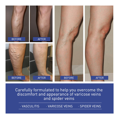 L Varicose Vein Patch Varicose Vein Patch Spider Vein Legs S