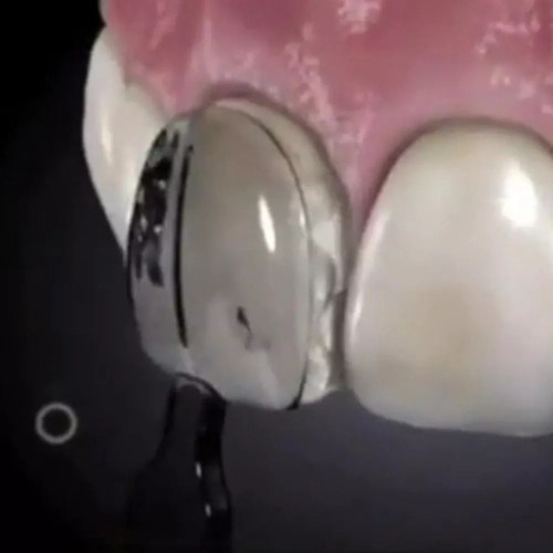 Sistema De Folheado Dentário Uveneer Similar De 32 Unidades