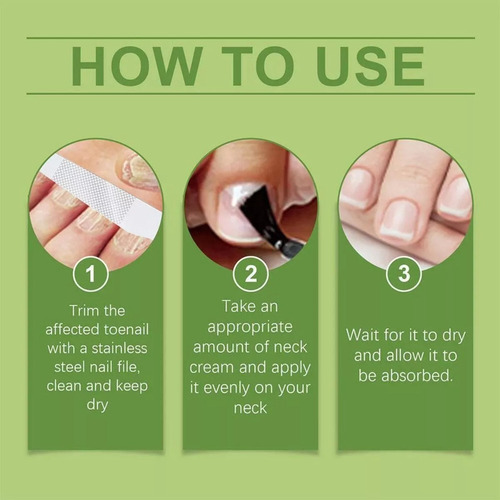 Los Hongos De Las Uñas Tratan Los Dedos De Los Pies Antifúng