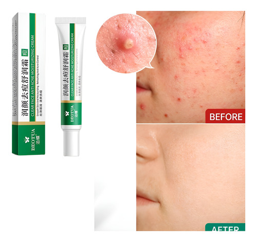 Melhor Creme Antiacne Fecha Poro Desinflama Todo Tipo De Pele Dia/noite
