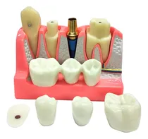 Comprar Modelo De Implante Dental Con Puente De Coronas Removibles