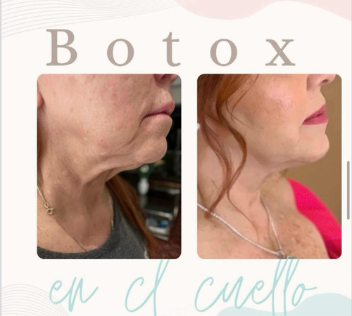 Aplicación De Botox (toxina Botulínica)
