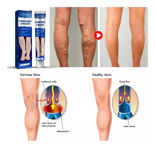 3pcs Pomada Tratamento Varize Vasinhos Veia Nas Pernas Creme
