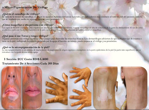 Sufres De Vitiligo Cubrelo En Secreto Micro-pigmentación