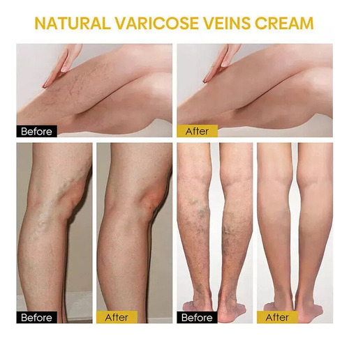3×crema Reparadora Venas Varico Con Veneno Abeja