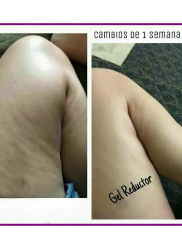 Gel Elimina Estrias Celulitis Circulacion 