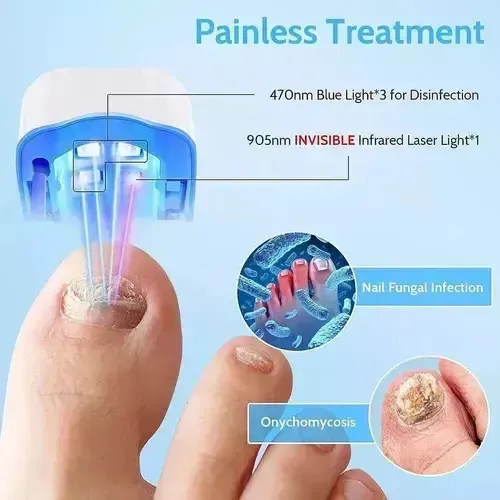 1 Láser Para Eliminar Hongos En Las Uñas. Onicomicosis De | Meses sin  interés