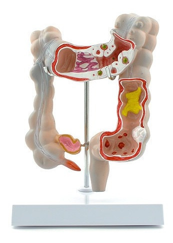 Colon Humano Con Diversos Cuadros Clinicos