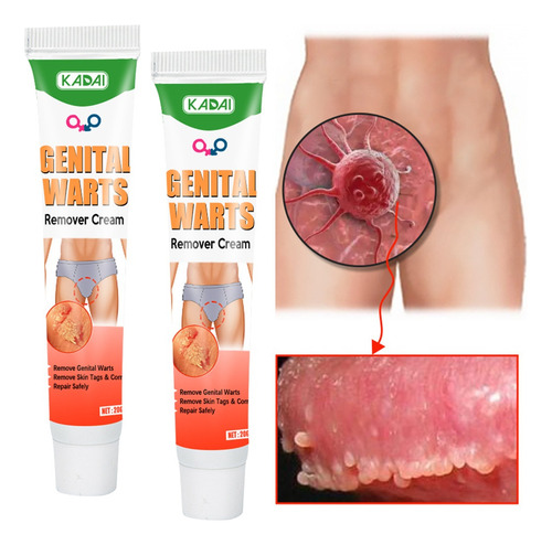 Ungüento Para Verrugas Con Ácido Salicílico,pacote Com 2 .