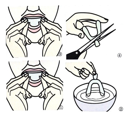 Brackets Dentales Blanqueadores Termoplásticos/pack 4 Pcs