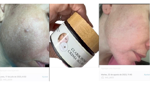 Crema Antimanchas Facial Paño Melasma Cicatrices Acne