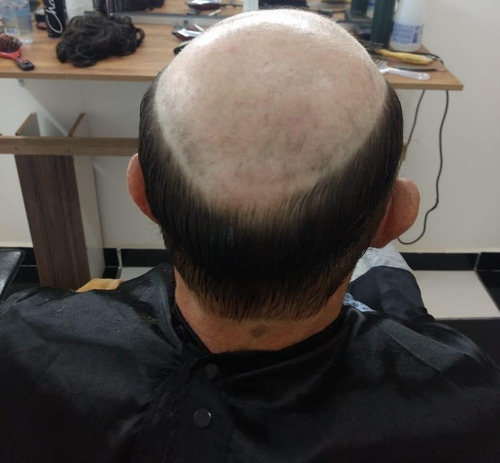 Prótese Capilar Micropele Hd Cabelo Humano #1b Preto Natural