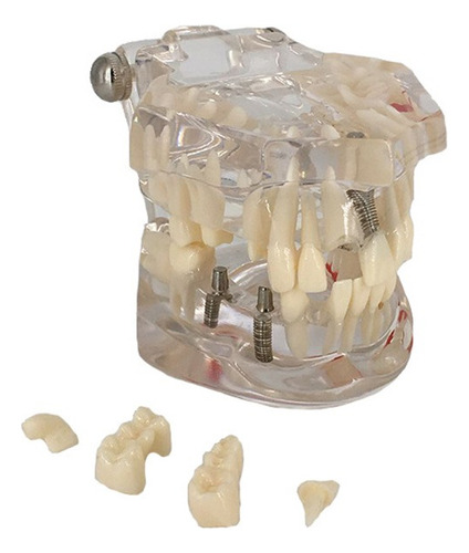 Manequim Modelo Odontológico Dentário Implante Prótese