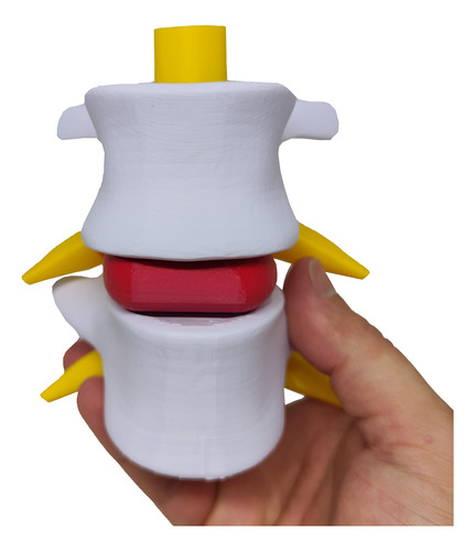 Modelo Anatômico Hérnia Disco Coluna Vertebral 3d