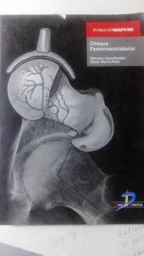 Choque Femoroacetabular