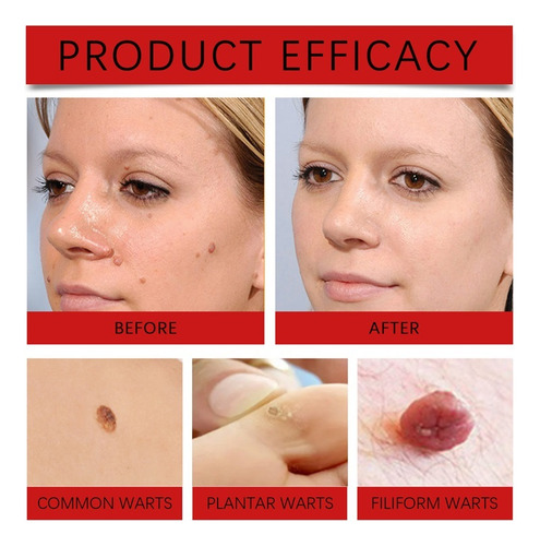 Mp Parche For El Cuidado De La Piel Keyou Nevus