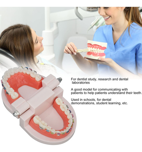 Modelo De Dientes De Ortodoncia Con Soportes De Metal De