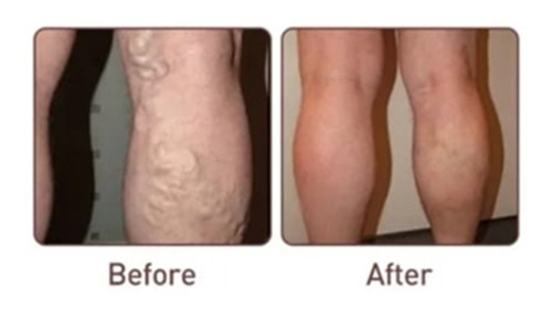 Sumifun - 2 Cremas Para Flebitis, Venas Varicosas, Varices