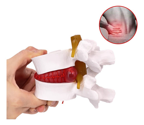 Modelo De Vértebras Lumbares: Columna Anatómica Hernia D