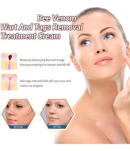 Crema Para Eliminar Verrugas De La Piel 20g