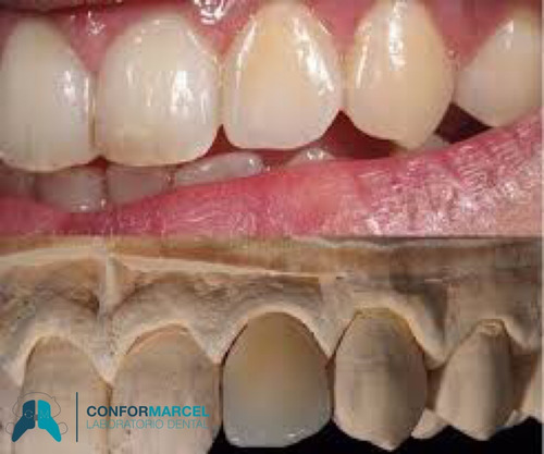 Imagen 7 de 10 de Prótesis Dentales Removibles Y Fijas