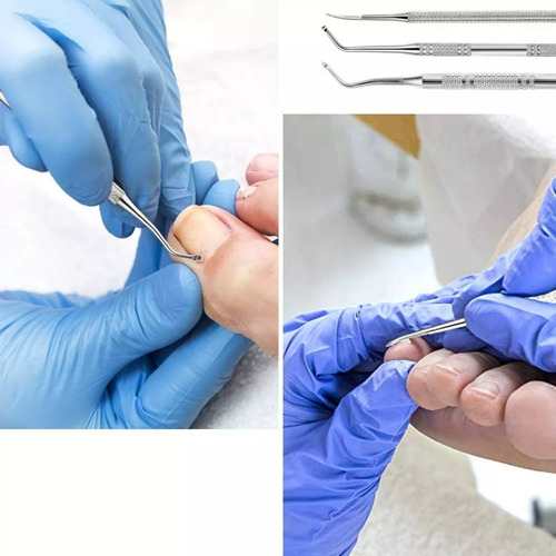 3pcs Herramienta Para Uñas Encarnadas Lima Uñas Del Pie