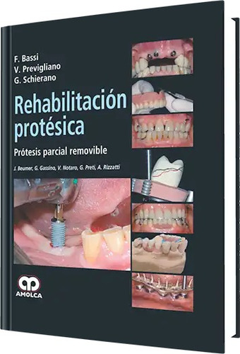 Rehabilitación Protésica. Prótesis Parcial Removible