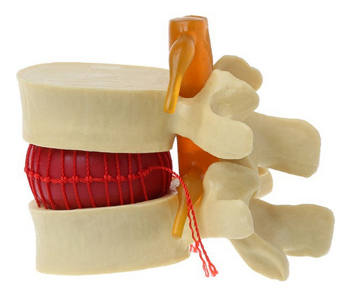 Modelo De Vértebras Lumbares: Columna Anatómica, Hernia D