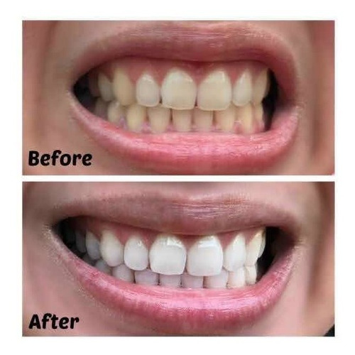 Kit Blanqueador De Dientes Profesional 6 Jeringa Luz Led Usa