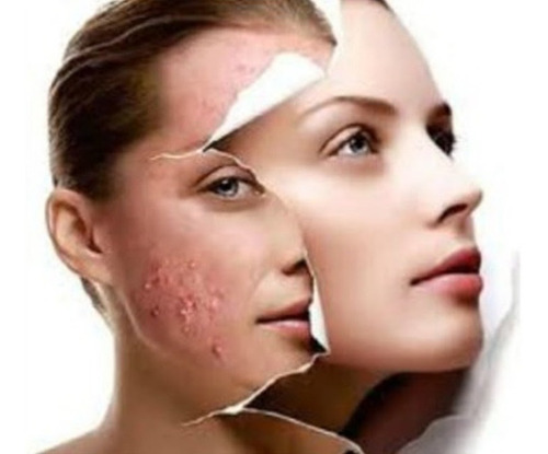 Lapiz Secativo P/ Acne E Imperfecciones Cover Sec Lidherma Momento De Aplicación Día/noche Tipo De Piel Grasas