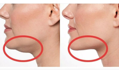 Mascarilla Tensora Reductora De Papada Y Contorno Facial