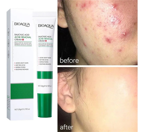 Crema Acne Removal Bioaqua Quita Acne Cicatrices Poros Contr